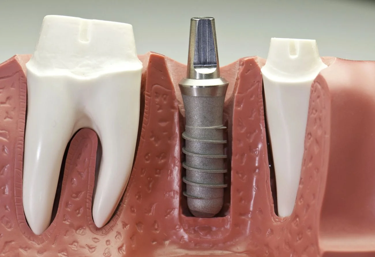 Czy implanty zębów są bezpieczne? Najważniejsze fakty